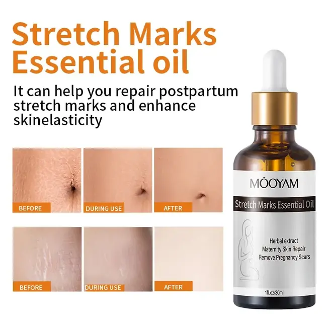 Stretch Marks Essential Oil - Image 3