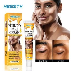 HBESTY Vitiligo Care Cream – White Spot & Skin Tone Repair Solution