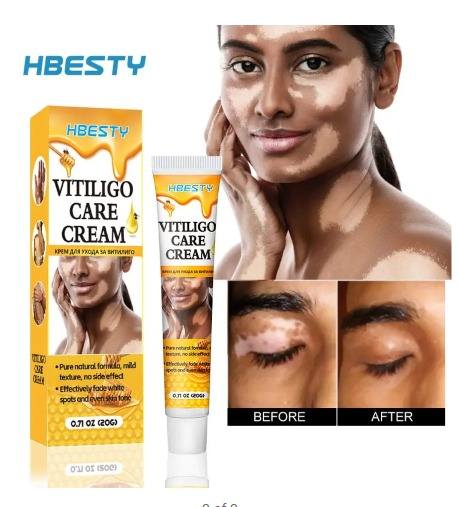 HBESTY Vitiligo Care Cream – White Spot & Skin Tone Repair Solution
