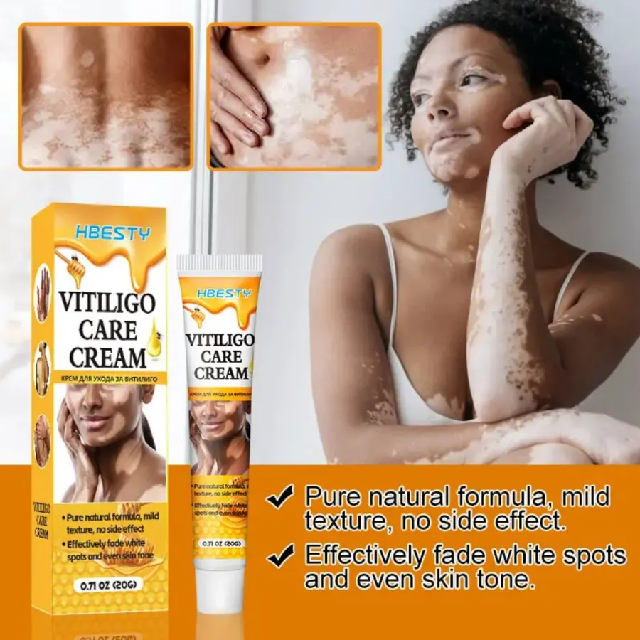 HBESTY Vitiligo Care Cream – White Spot & Skin Tone Repair Solution - Image 4