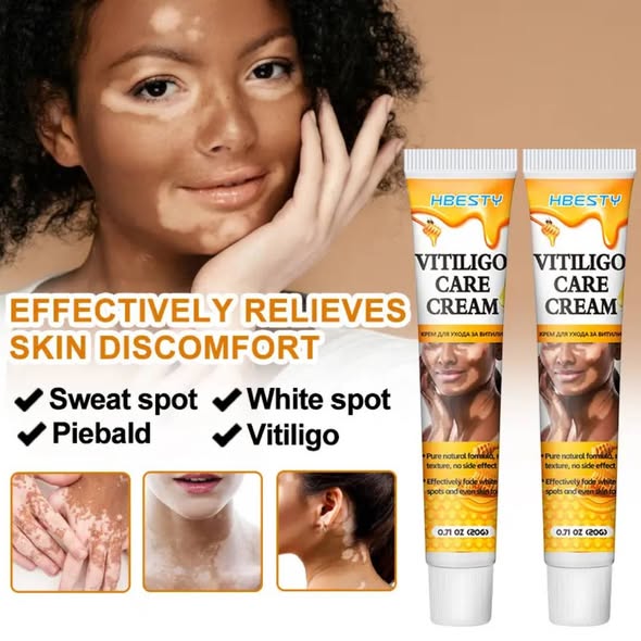 HBESTY Vitiligo Care Cream – White Spot & Skin Tone Repair Solution - Image 3