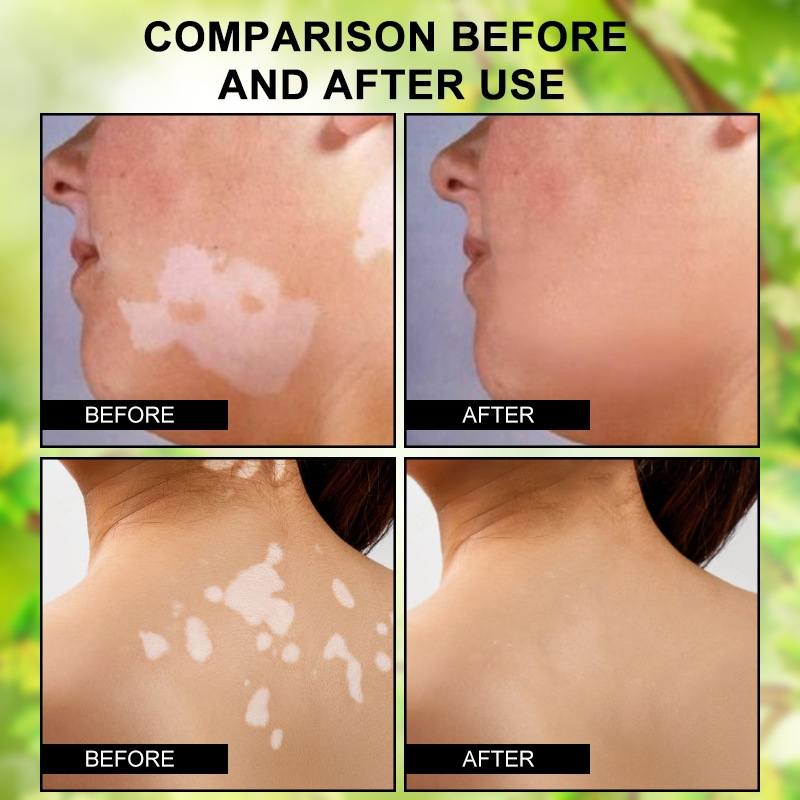 HBESTY Vitiligo Care Cream – White Spot & Skin Tone Repair Solution - Image 2
